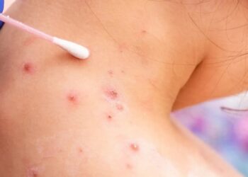MINSA refuerza vigilancia epidemiológica tras emergencia sanitaria por viruela del mono